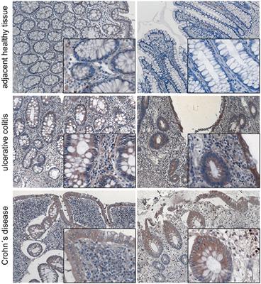 Pro-inflammatory TNF-α and IFN-γ Promote Tumor Growth and Metastasis via Induction of MACC1